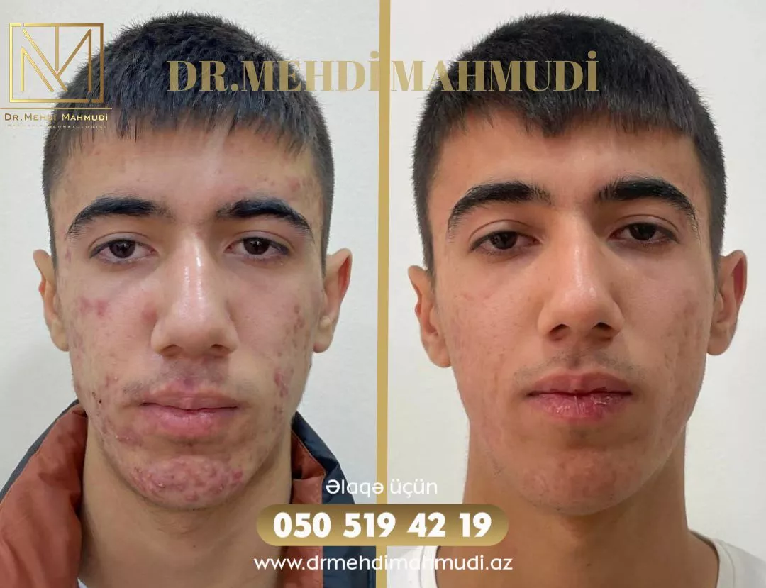 Çapıq - Xəstə7 - Kosmetik Dermatoloq Akne Klinik