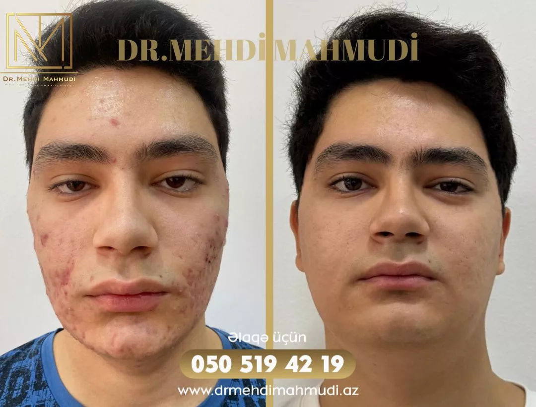 Çapıq - Xəstə5 - Kosmetik Dermatoloq Akne Klinik