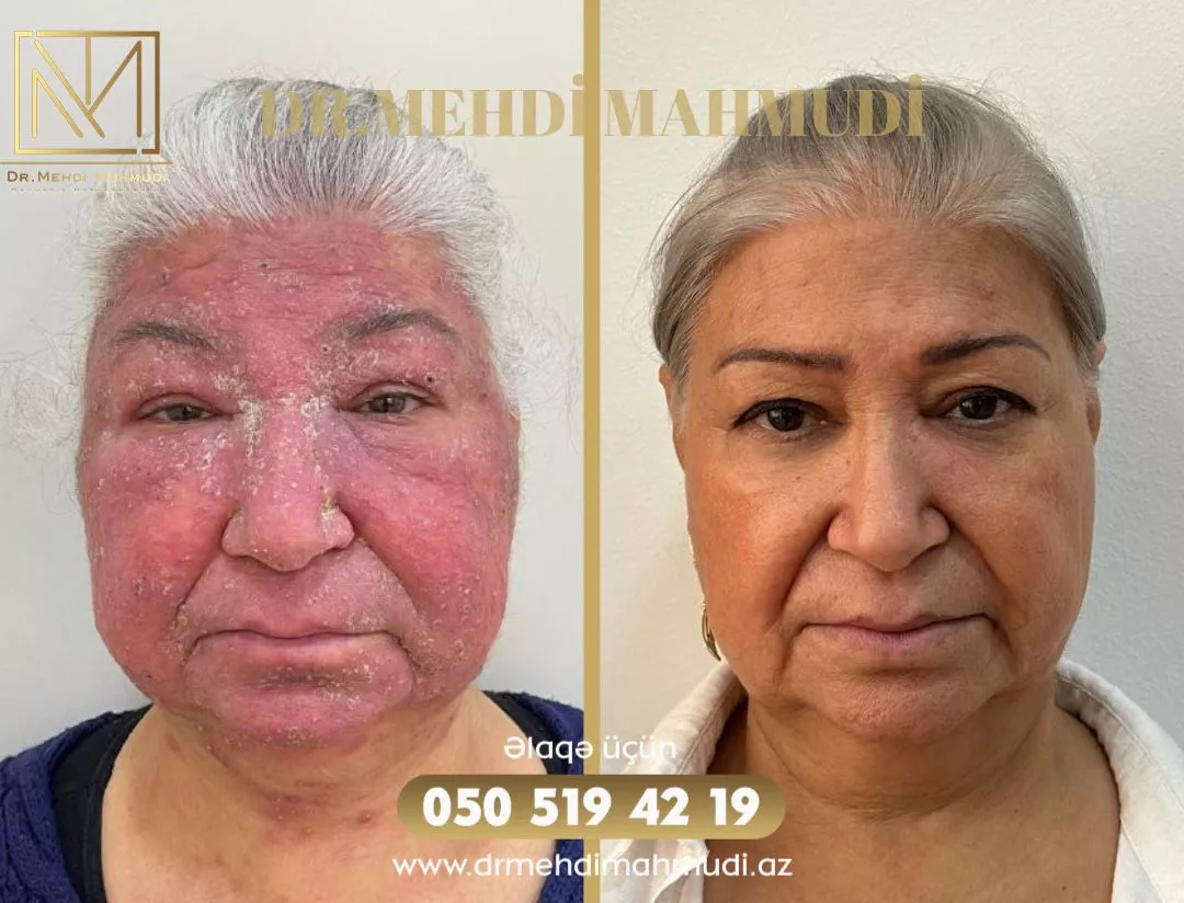 Çapıq - Xəstə9 - Kosmetik Dermatoloq Akne Klinik